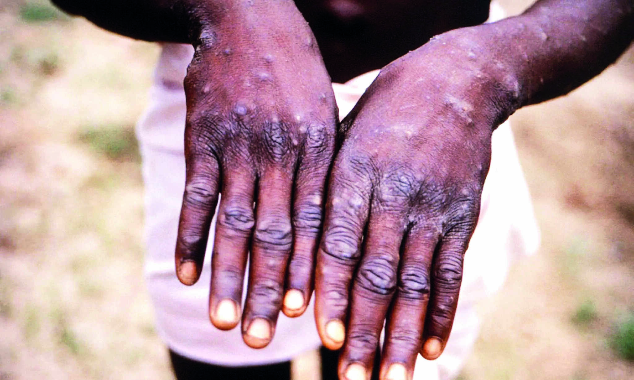 ICMR-NIV analysis finds A.2 strain of monkeypox virus in 1st two cases