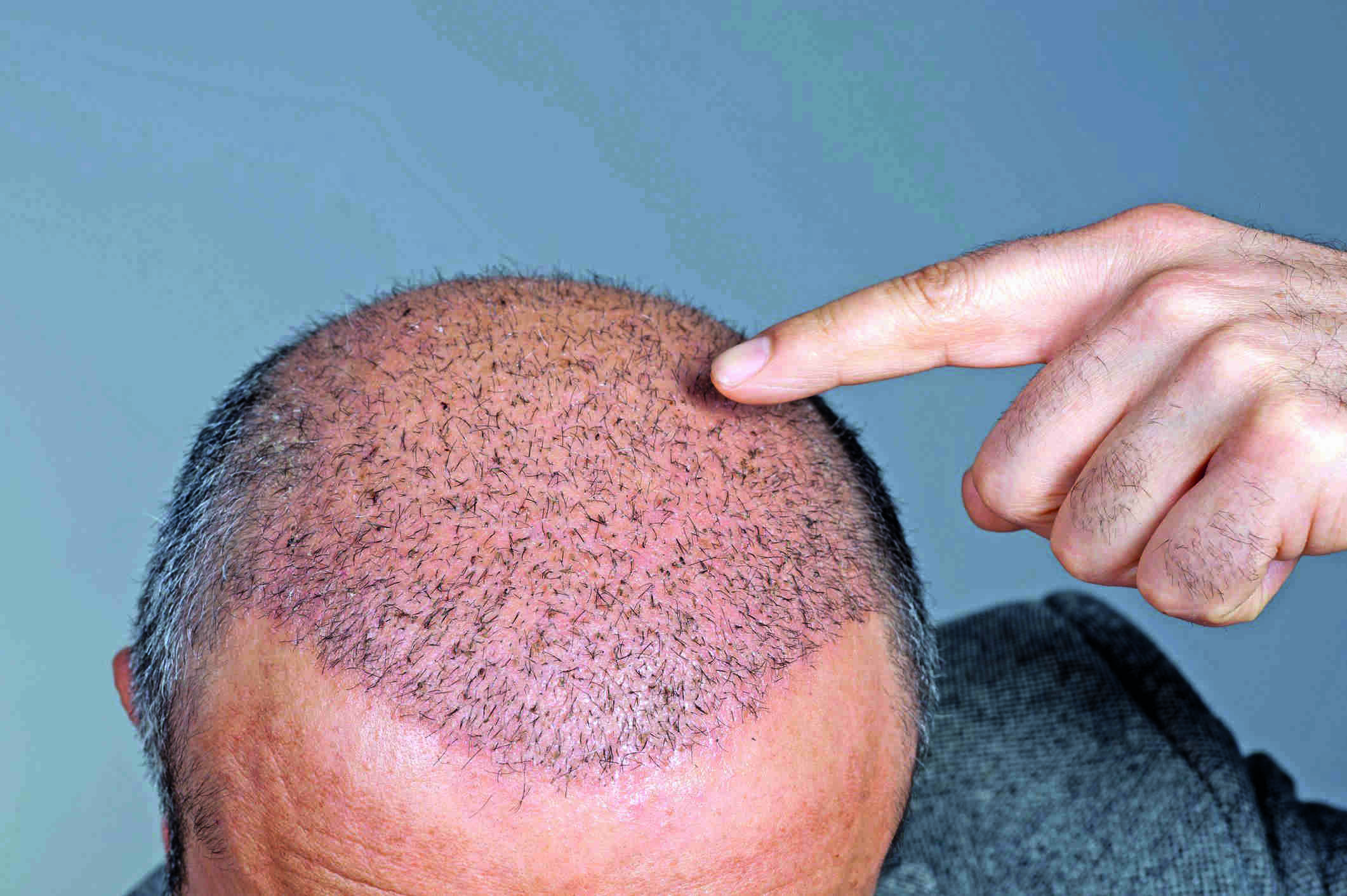 HC expresses concern over hair transplant by unprofessionals HC expresses concern over hair transplant by unprofessionals