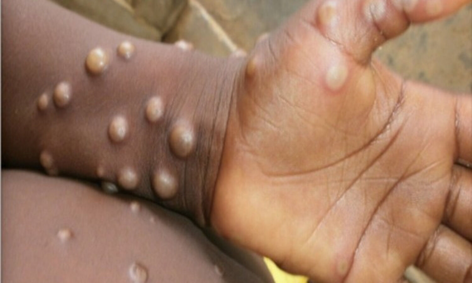 Monkeypox case in Delhi, Indias tally climbs to four