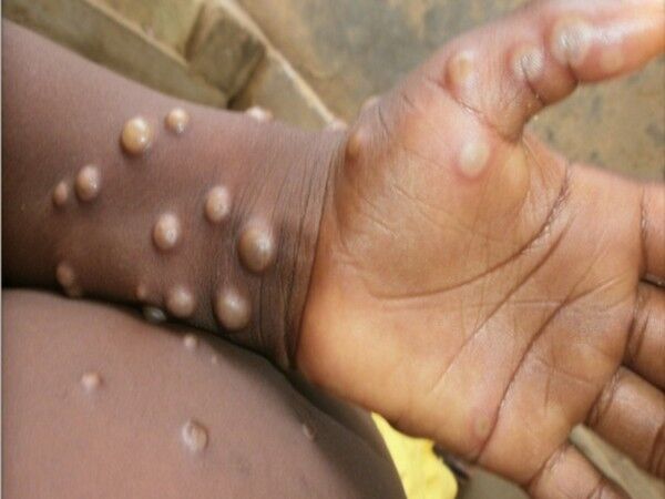Monkeypox case in Delhi, Indias tally climbs to four Monkeypox case in Delhi, Indias tally climbs to four