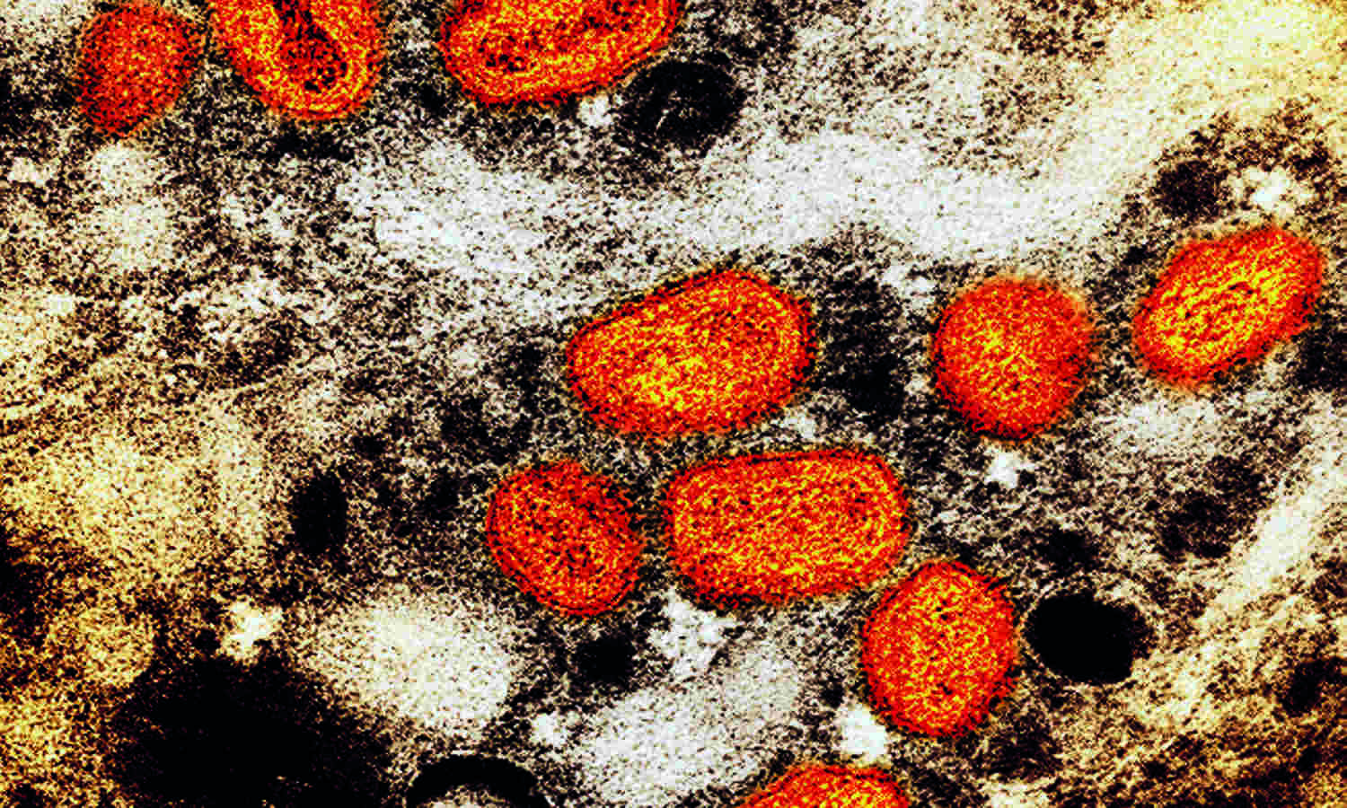 Monkeypox declared a public health emergency in NYC