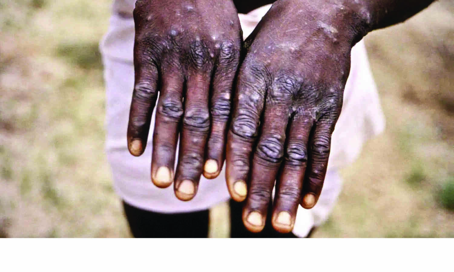 Monkeypox: Health ministry releases dos and donts