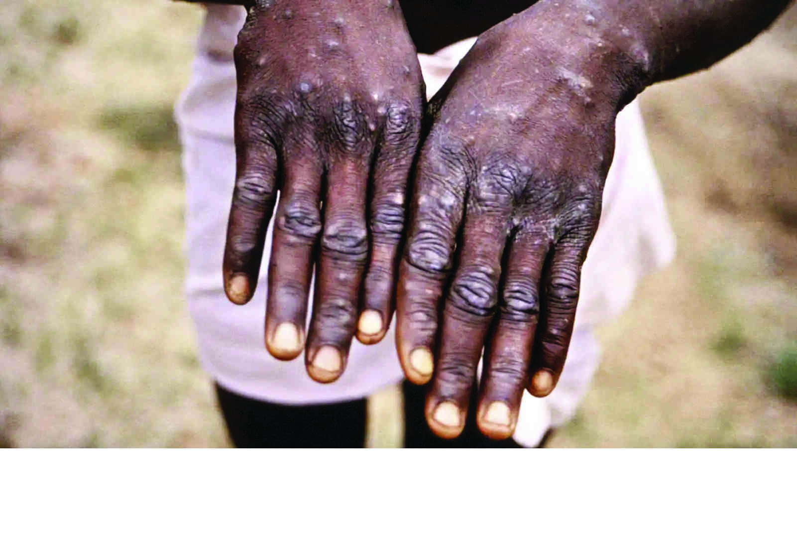 Monkeypox: Health ministry releases dos and donts