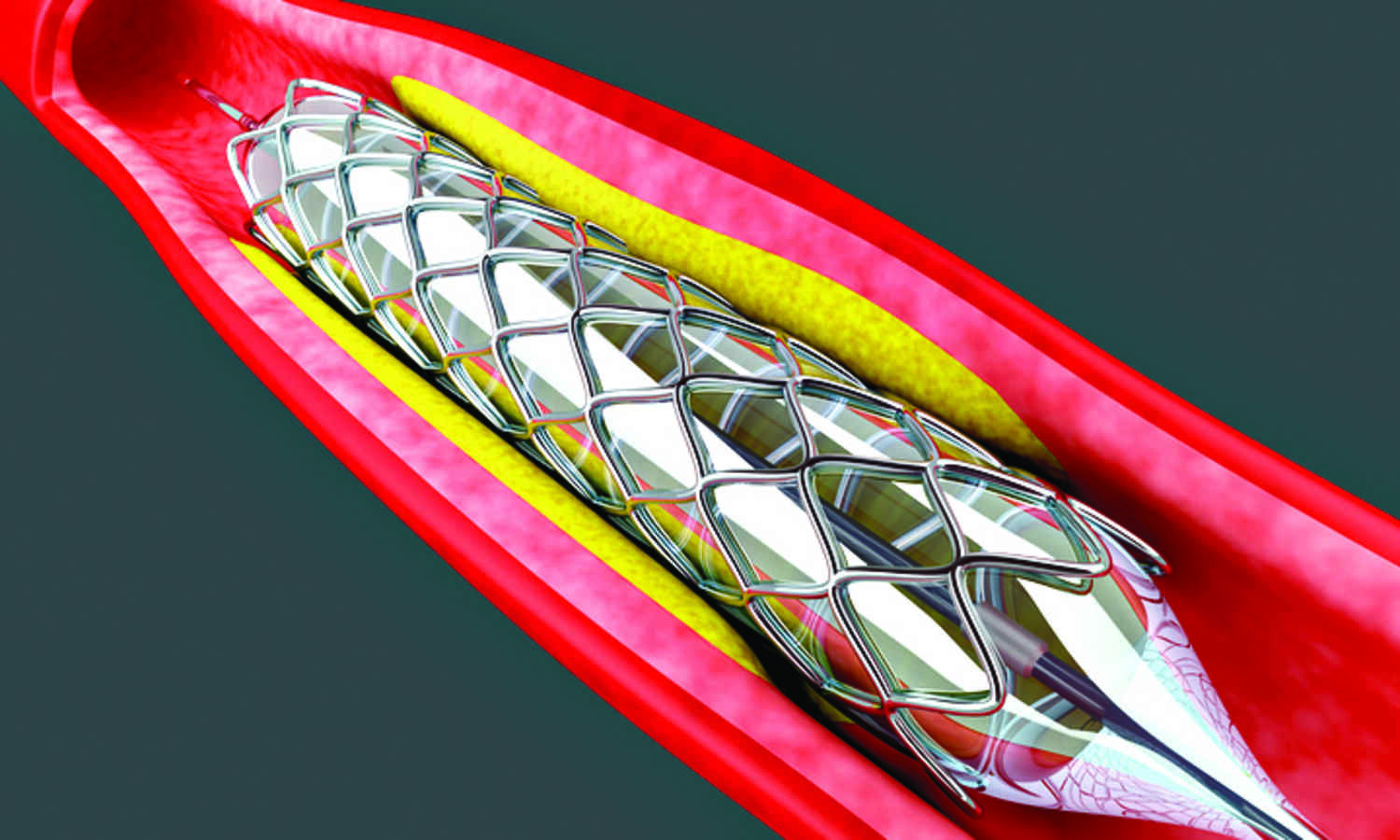 Health Min includes coronary stents in Natl List of Essential Medicines, 2022
