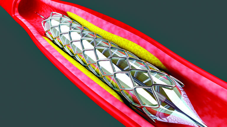 Health Min includes coronary stents in Natl List of Essential Medicines, 2022