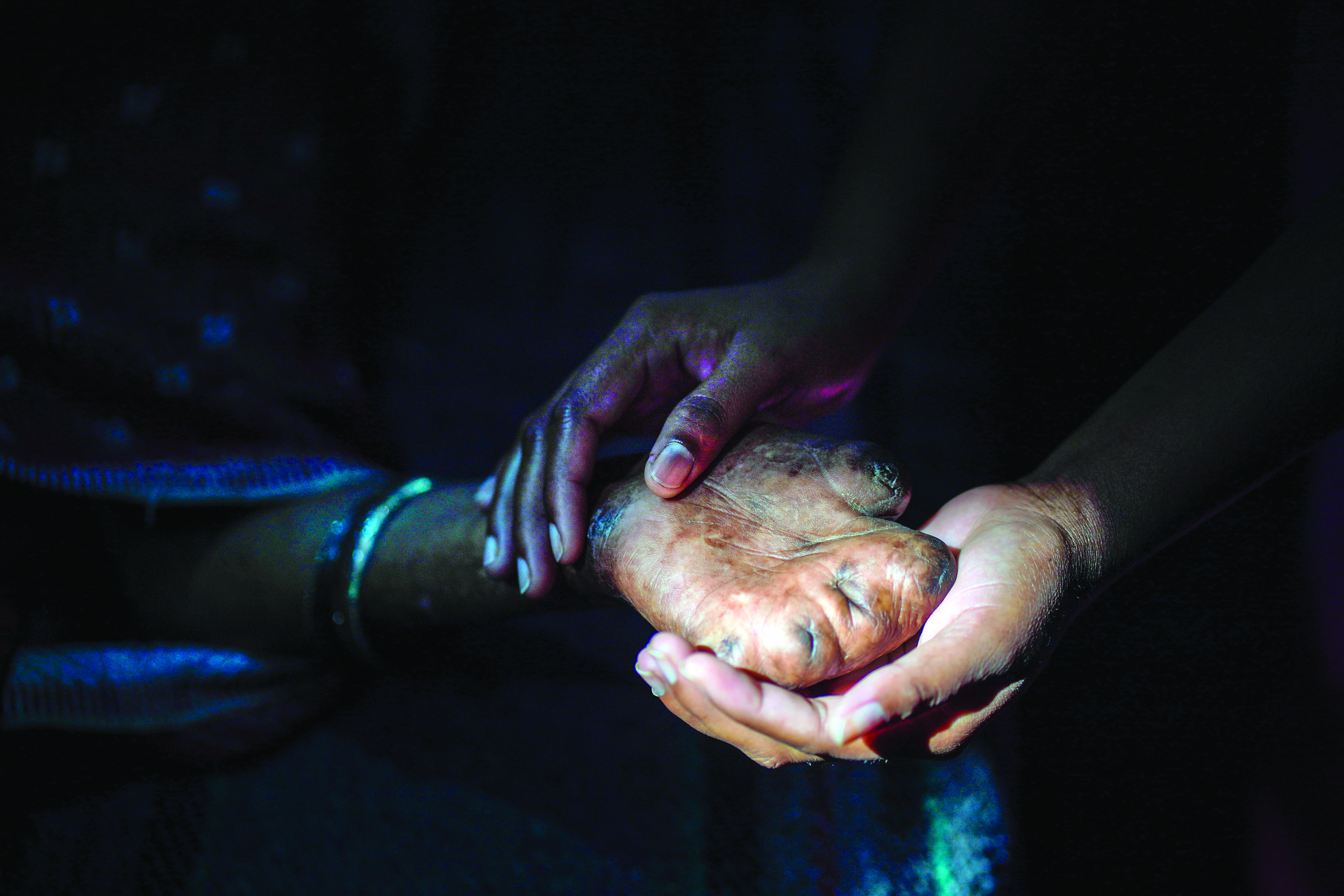 Urgently address gaps in leprosy services disrupted by COVID-19 pandemic: WHO Urgently address gaps in leprosy services disrupted by COVID-19 pandemic: WHO