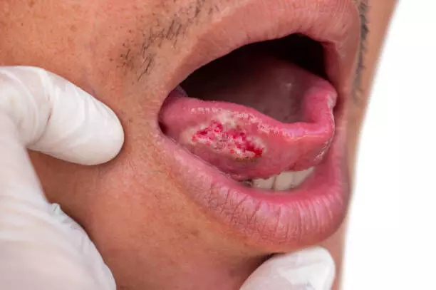 ‘Sharp rise in oral cancer among women in Bengal linked to tobacco use’ ‘Sharp rise in oral cancer among women in Bengal linked to tobacco use’