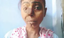 UP: Acid attack survivor receives Rs 5 lakh   compensation after 28 years UP: Acid attack survivor receives Rs 5 lakh   compensation after 28 years
