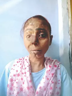 UP: Acid attack survivor receives Rs 5 lakh   compensation after 28 years UP: Acid attack survivor receives Rs 5 lakh   compensation after 28 years