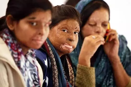 SC asks states, UTs to provide details of acid attack cases SC asks states, UTs to provide details of acid attack cases