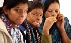 SC asks states, UTs to provide details of acid attack cases